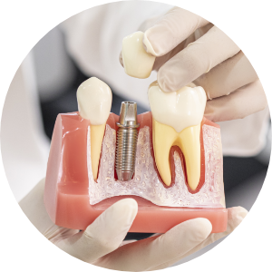 Dental Implant Process image3